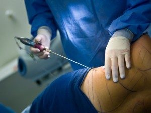 Chirurgien esthétique nicolas gounot lyon : liposuccion