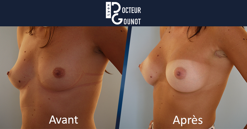 Augmentation mammaire à Lyon - Docteur Nicolas Gounot