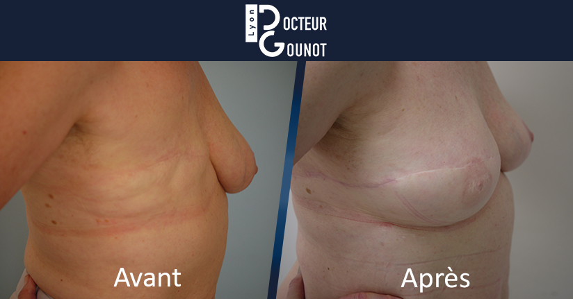 Chirurgie réparatrice des seins à Lyon : reconstruction mammaire