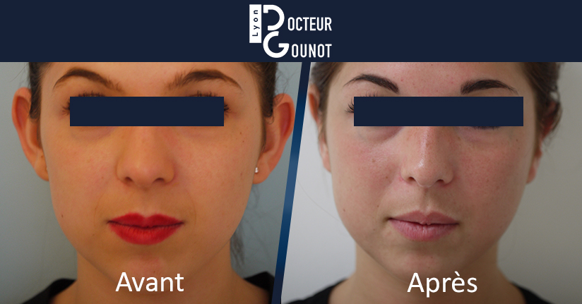 Alternatives à la chirurgie (otoplastie) – Traitement Oreilles Décollées