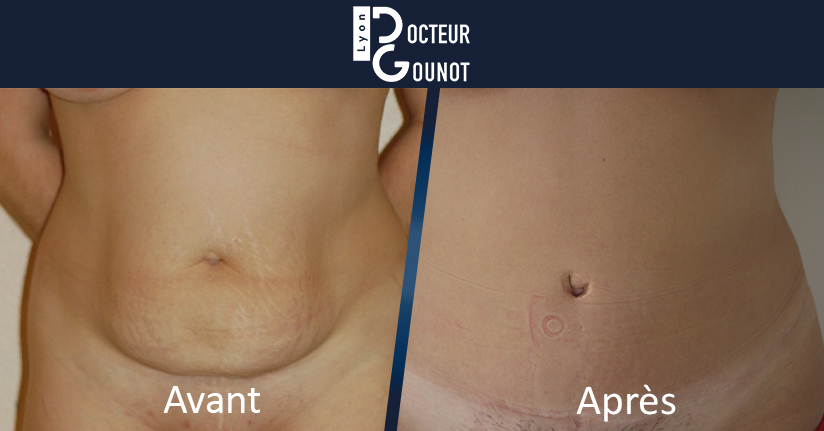 Abdominoplastie: quel poids avant une chirurgie réparatrice du ventre?